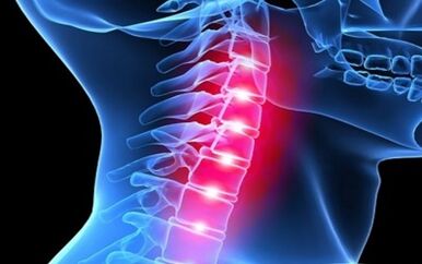 Symptoms of osteochondrosis of the cervical spine