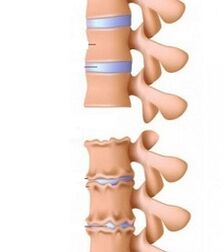 Stages of ramps of osteochondrosis of the neck