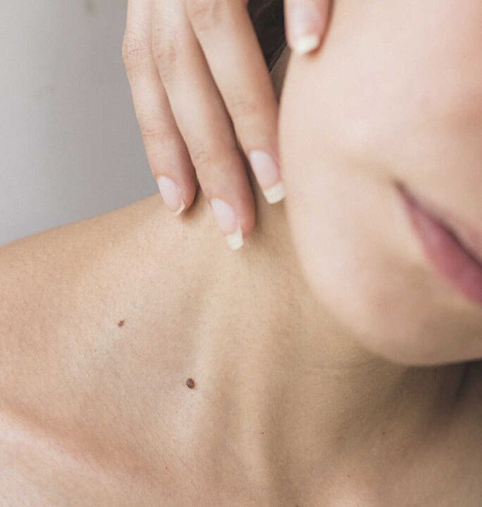 Stiffness in the neck is one of the symptoms of the initial stage of osteochondrosis of the cervical spine